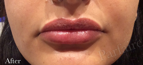 Lip Augmentation After by Parfaire