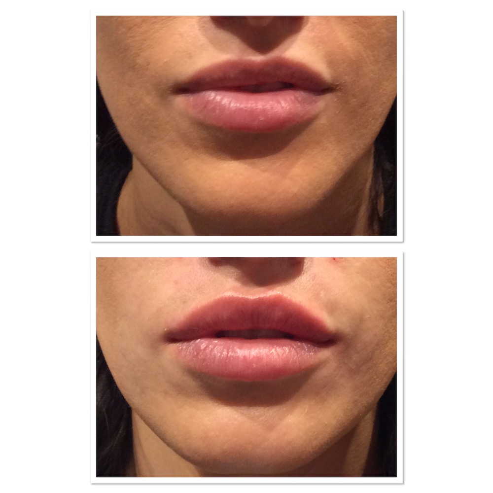 lipinjections4 Parfaire Medical Aesthetics