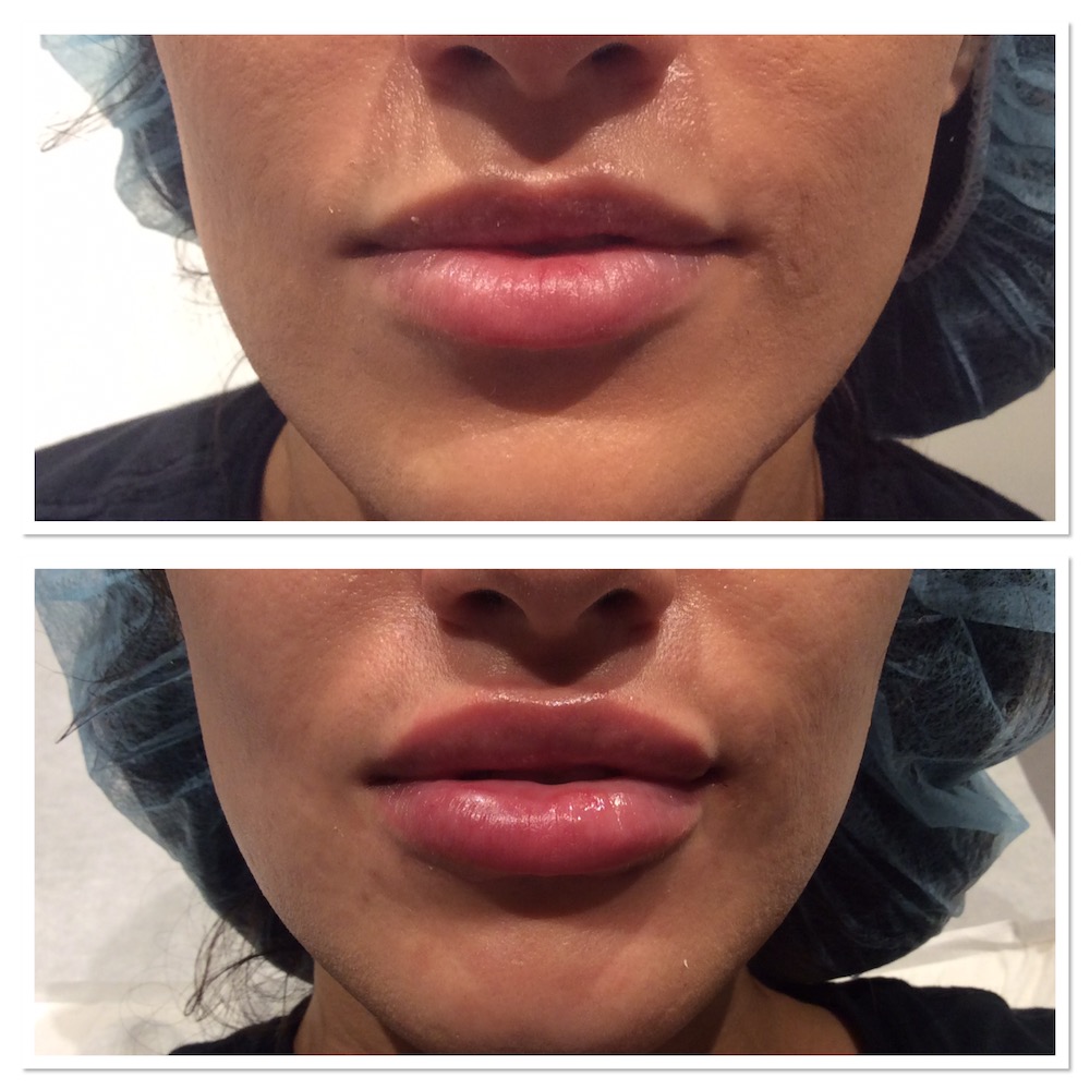 Post Care After Lip Injections at Eugene Riley blog