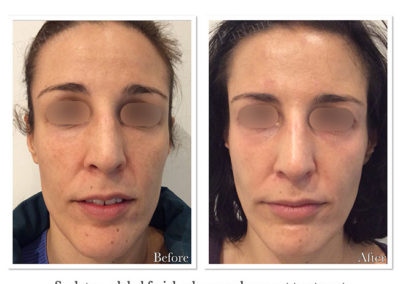 Facial Aging Treatments Before & After by Parfaire
