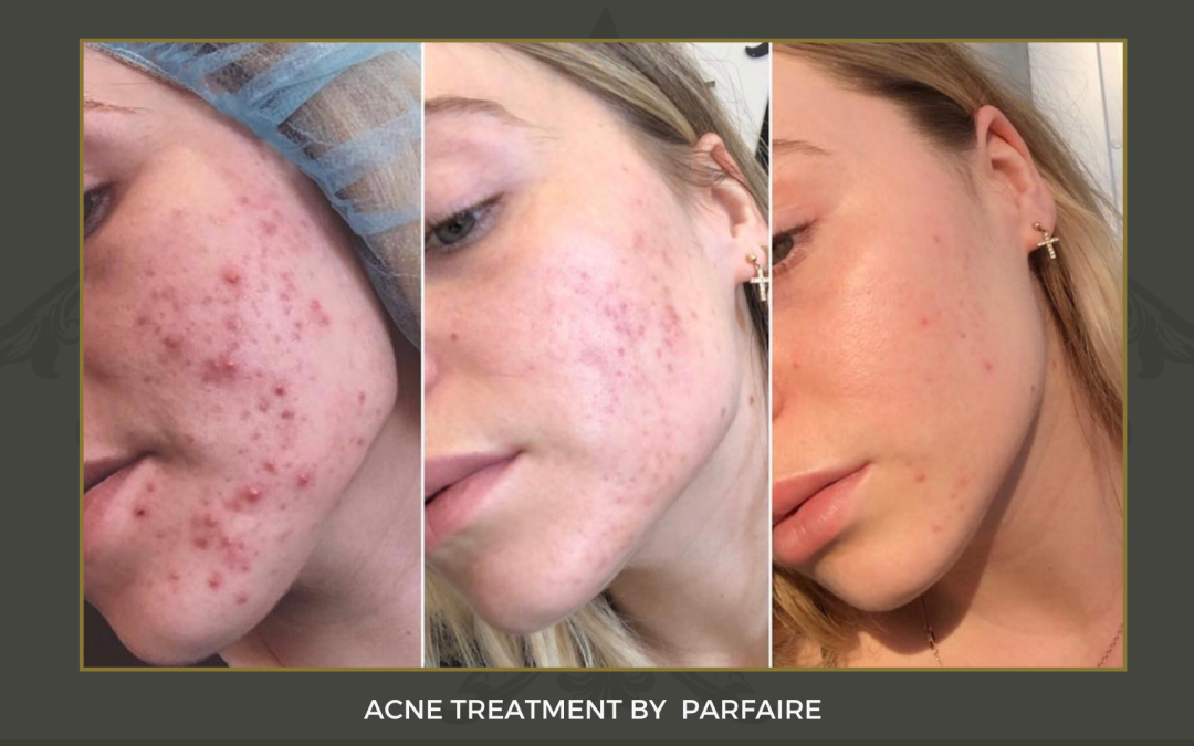 Acne Tx