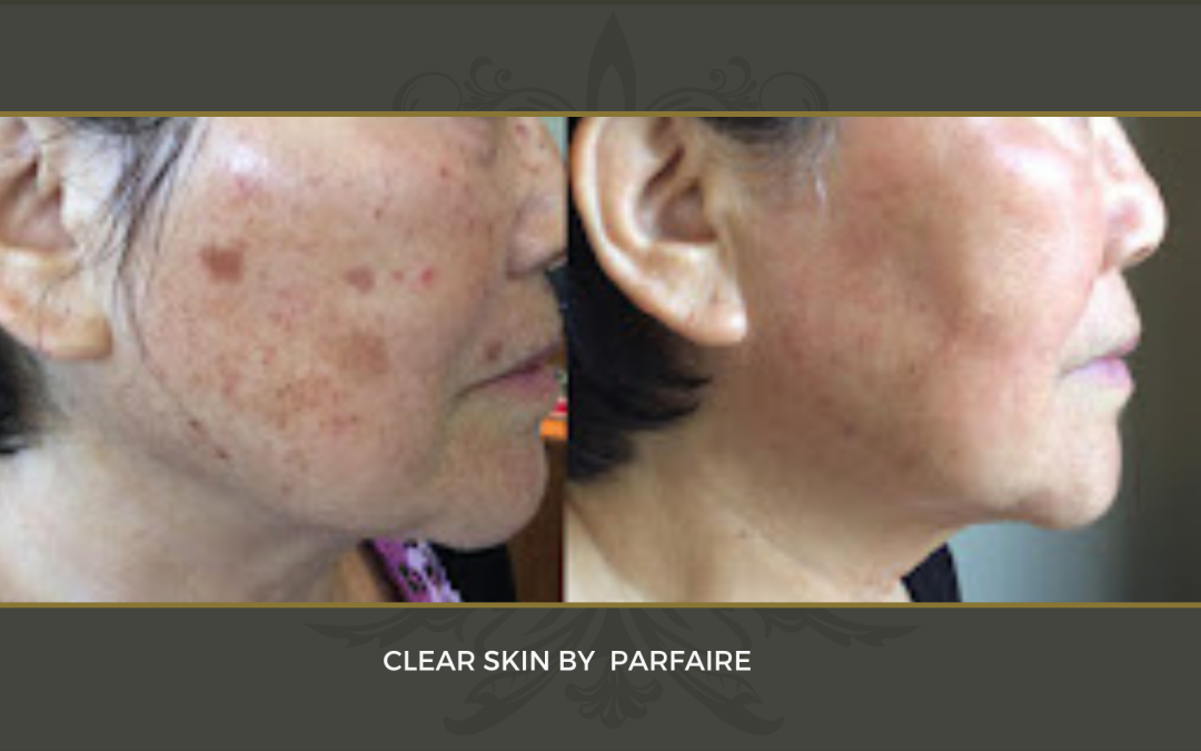 Clear Skin2