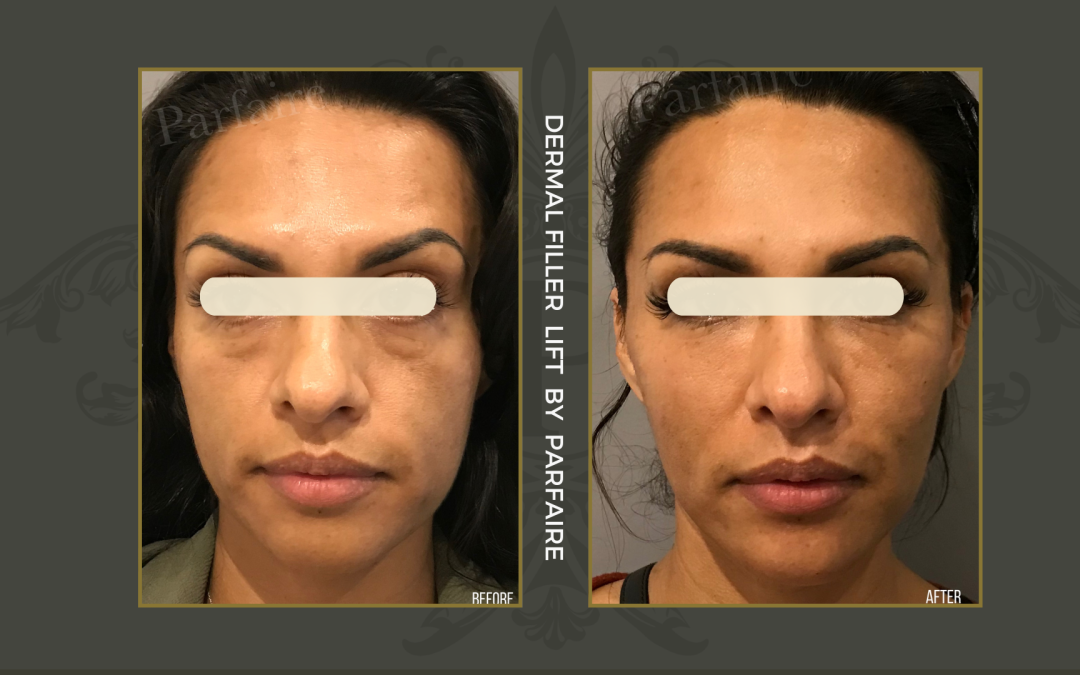 Filler Lift