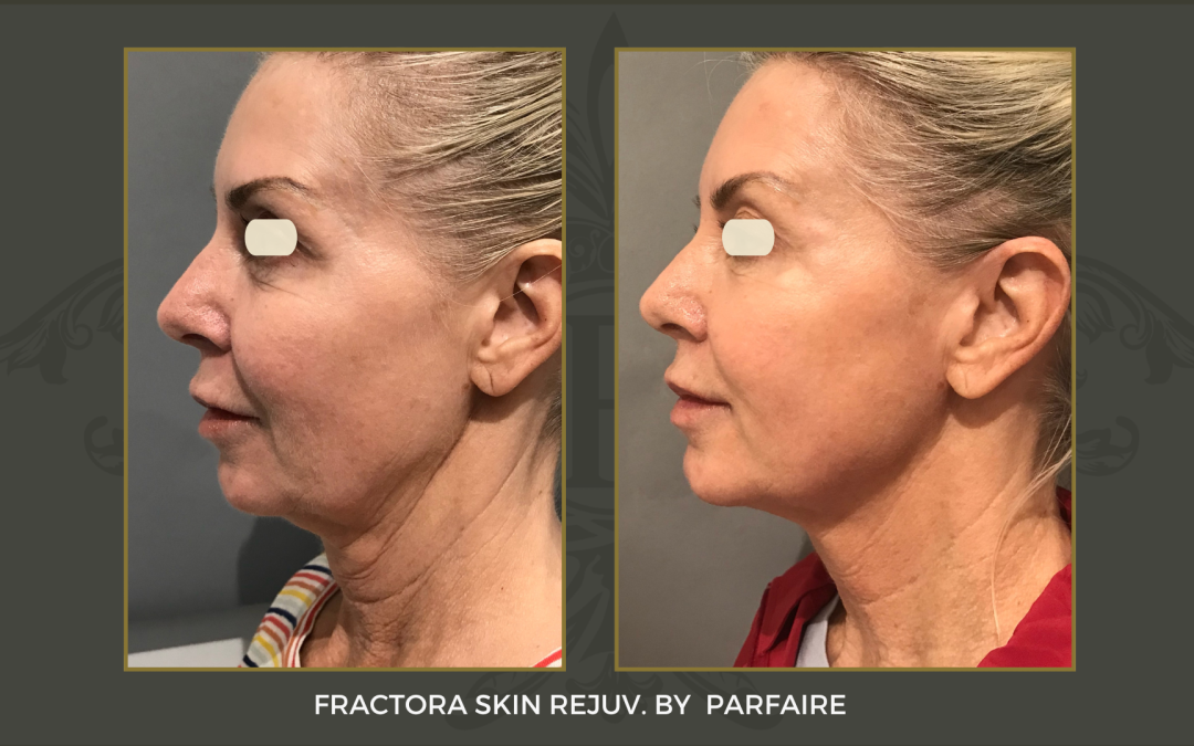 Fractora Skin Rejuv.