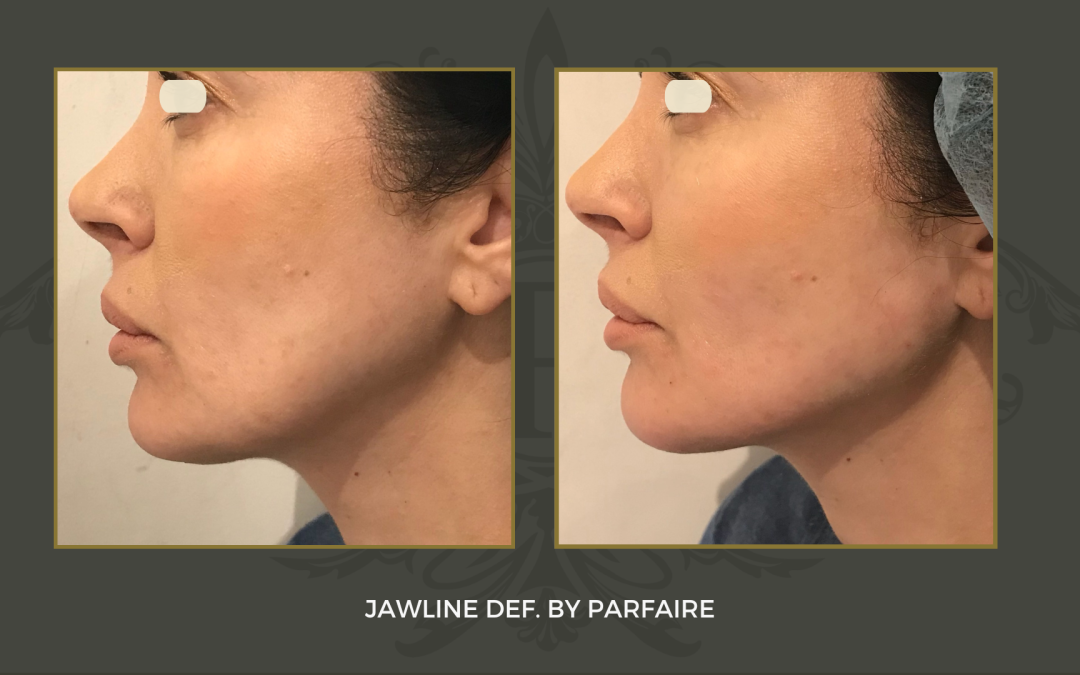 Jawline 2