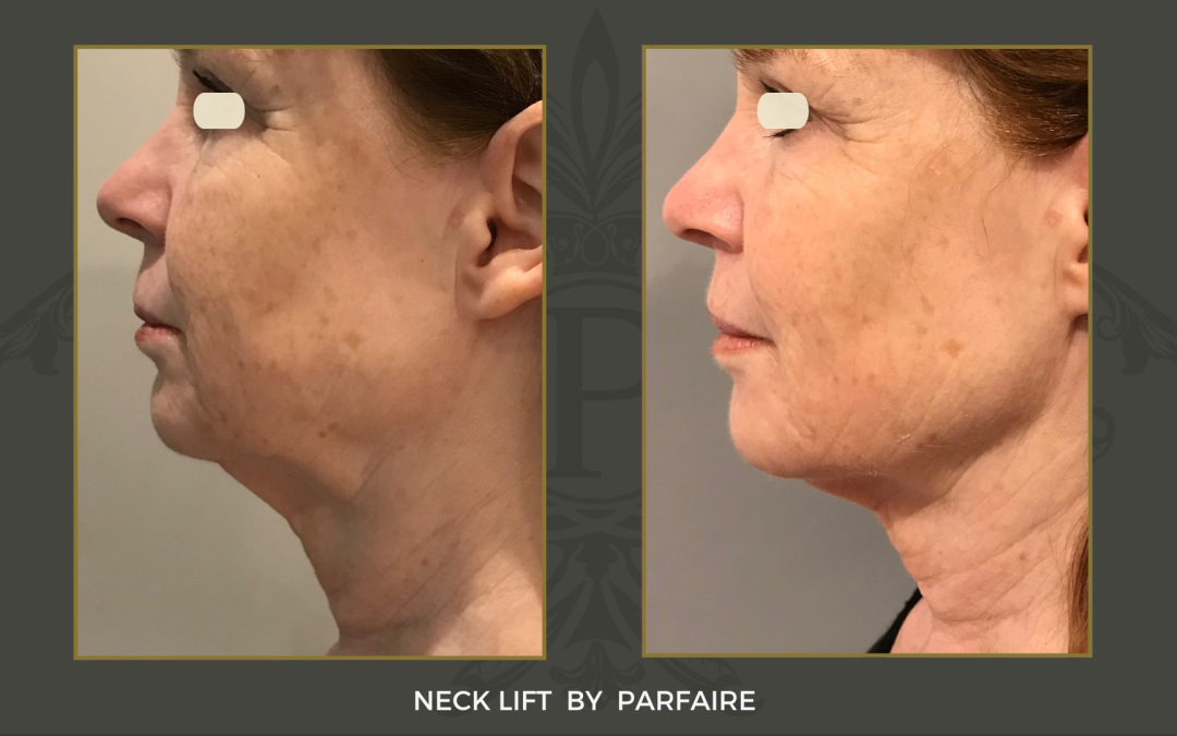 Neck lift 1