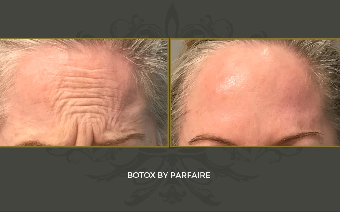 botox