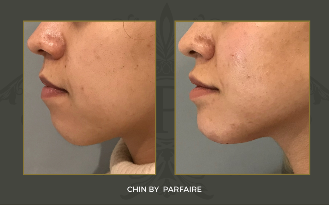 chin
