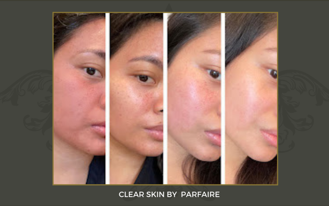 clearskin 1