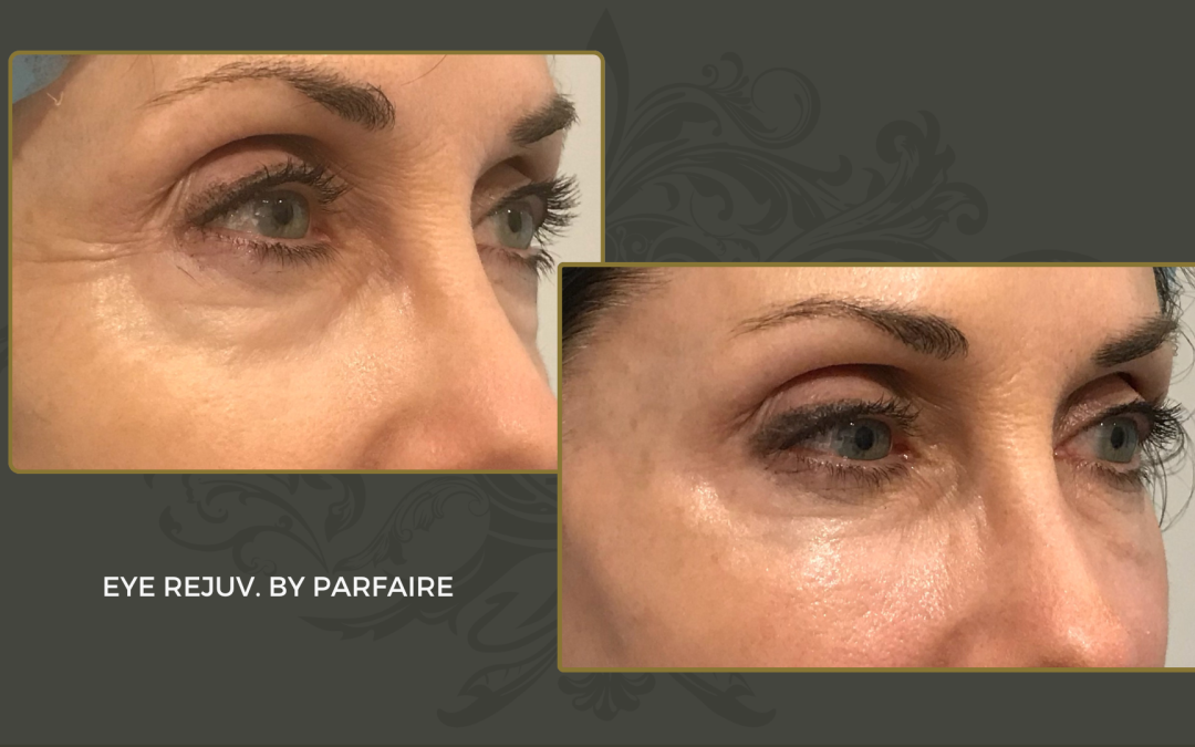 eye rejuv