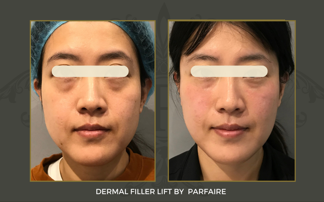 filler lift copy