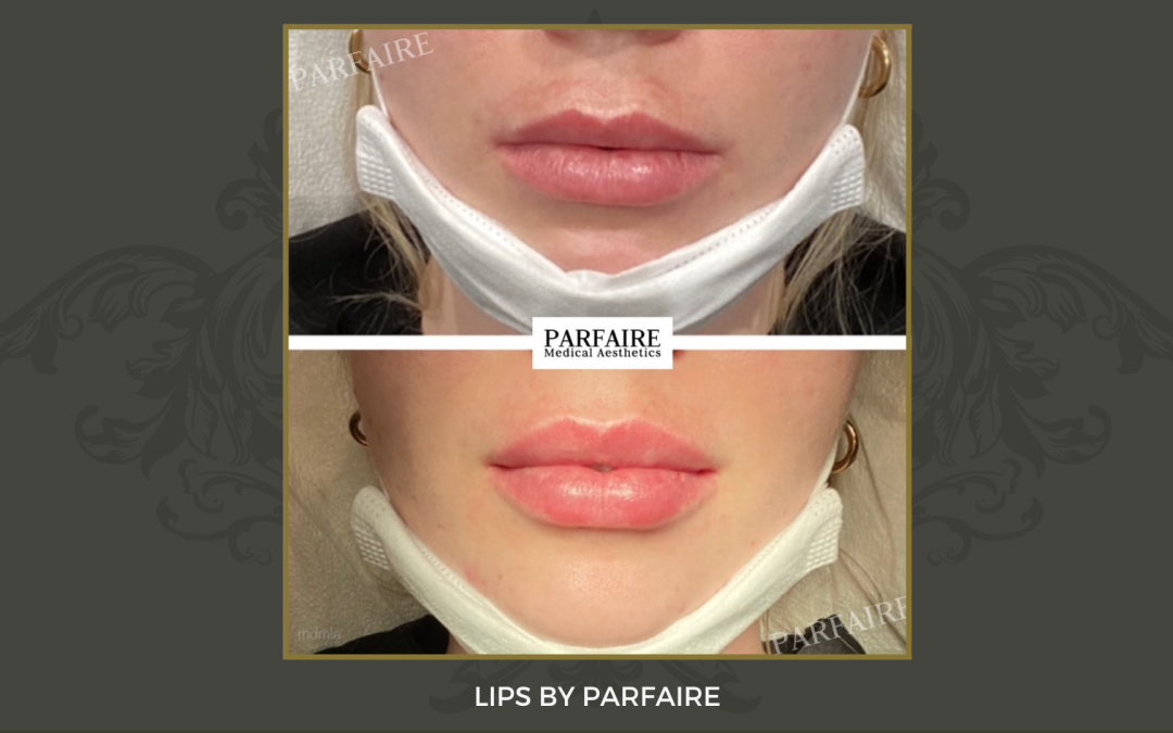 lips4