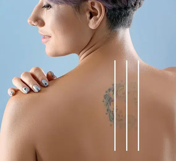 Tattoo-Removal Tattoo-Removal